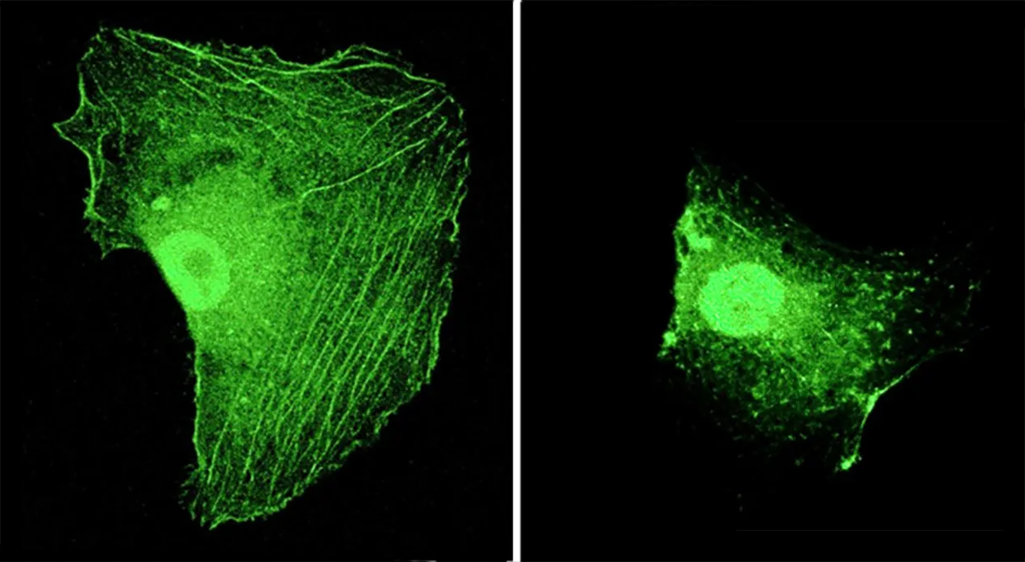 Impact de la stimulation magnéto-mécanique sur le cytosquelette de cellules cancéreuses de gliome