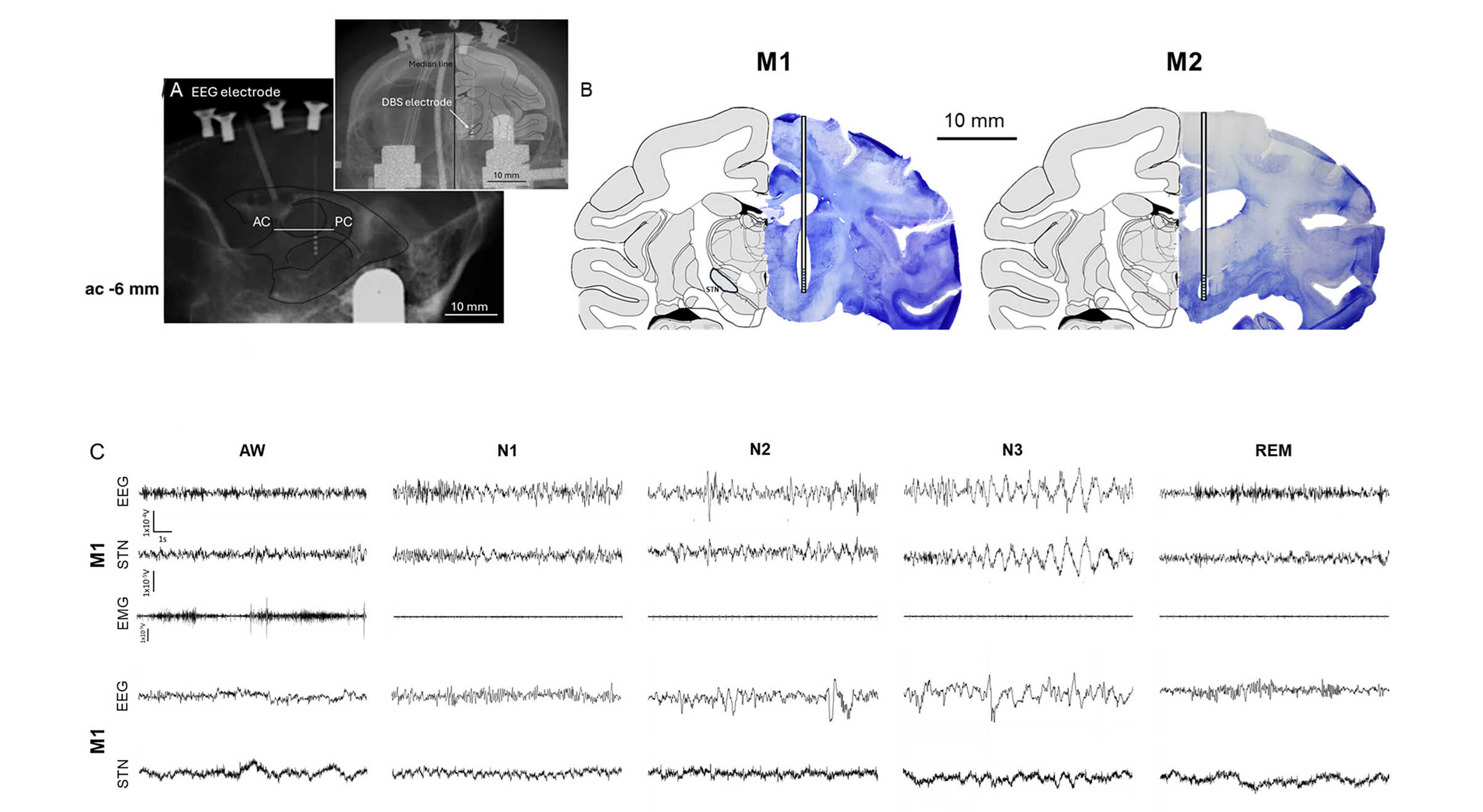Enregistrement EEG de neurones